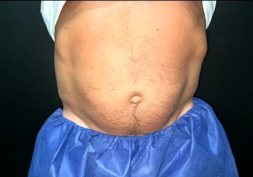 CoolSculpting Before & After Photo