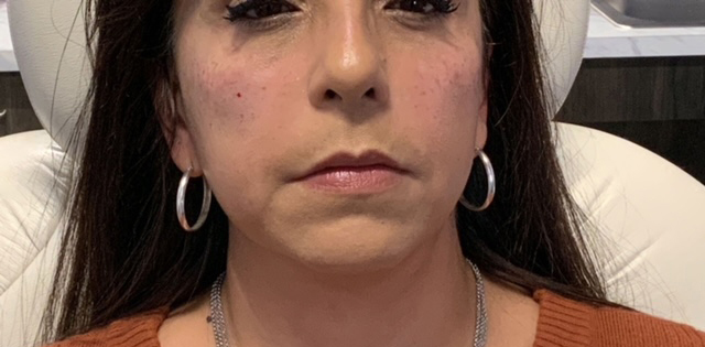 Facial Fillers Before & After Photo