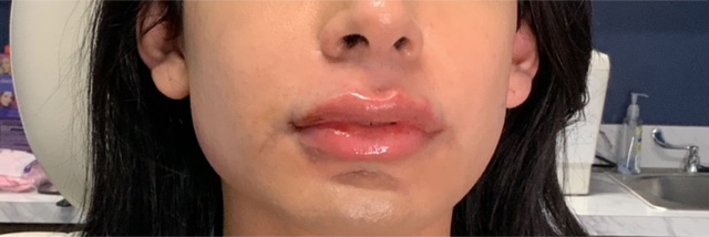 Lip Fillers Before & After Photo