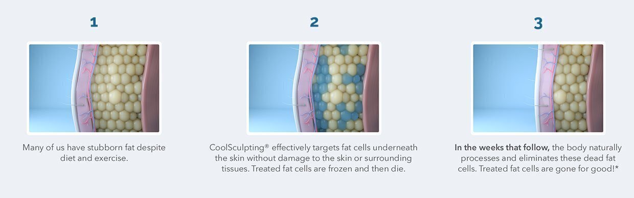 San Antonio CoolSculpting