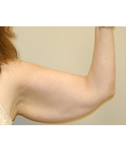 Arm Lift Before & After Photo