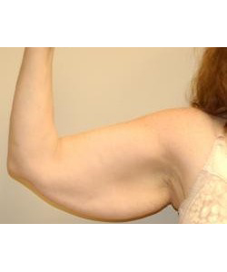 Arm Lift Before & After Photo