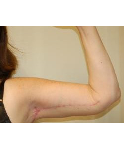 Brachioplasty Before & After