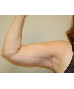Brachioplasty Before & After