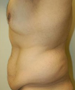 Body Lift Before & After Photo