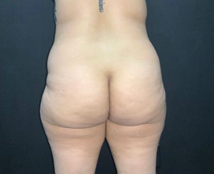 Brazilian Butt Lift Before & After Photo