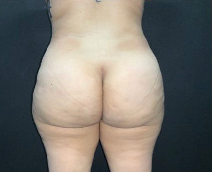 Brazilian Butt Lift Before & After Photo