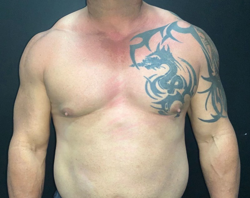 Gynecomastia Before & After Photo