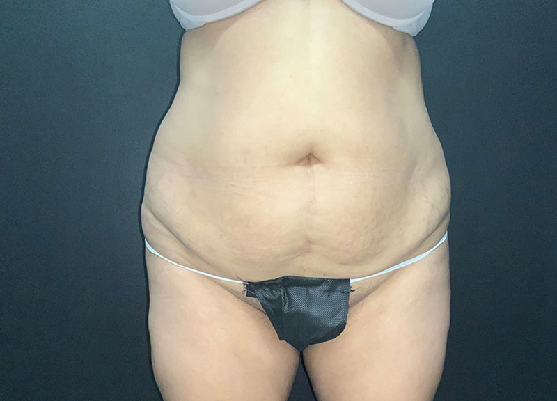 Liposuction Before & After Photo