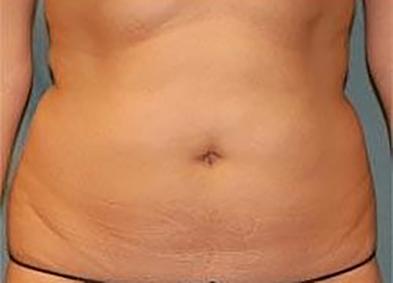 Liposuction Before & After Photo