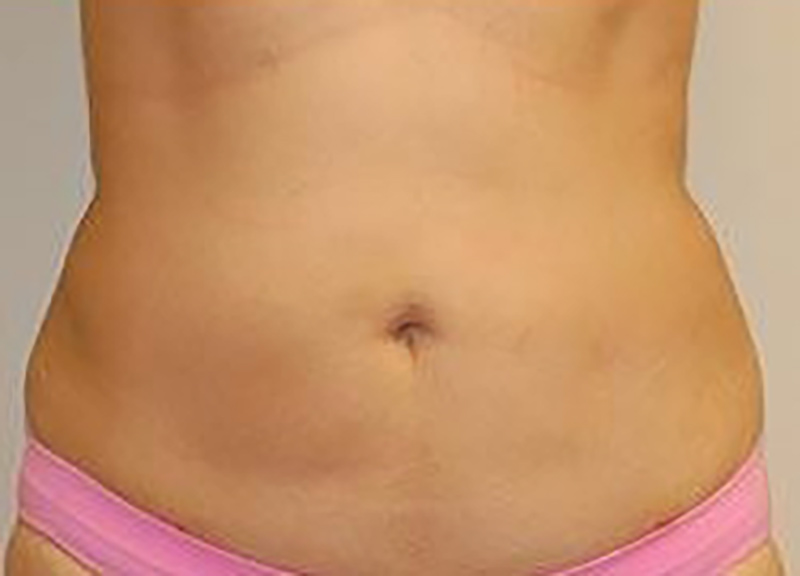 Liposuction Before & After Photo