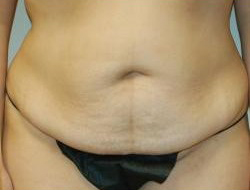 Tummy Tuck Before & After Photo