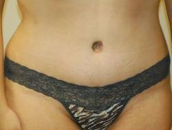 Tummy Tuck Before & After Photo