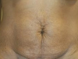 Tummy Tuck Before & After Photo