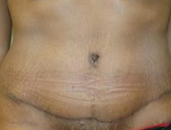 Tummy Tuck Before & After Photo