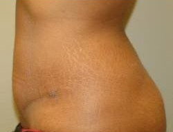 Tummy Tuck Before & After Photo