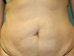 Tummy Tuck Before & After Photo