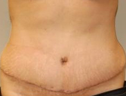 Tummy Tuck Before & After Photo