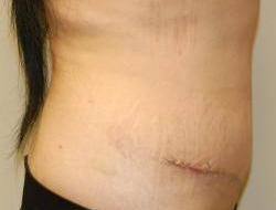 Tummy Tuck Before & After Photo