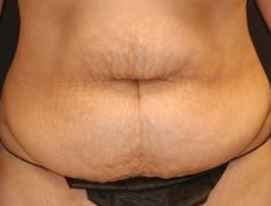 Tummy Tuck Before & After Photo