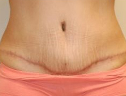 Tummy Tuck Before & After Photo