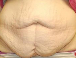 Tummy Tuck Before & After Photo