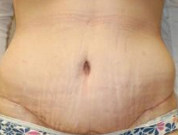 Tummy Tuck Before & After Photo