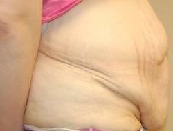 Tummy Tuck Before & After Photo