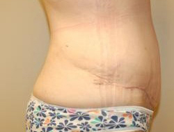 Tummy Tuck Before & After Photo