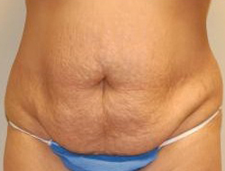 Tummy Tuck Before & After Photo