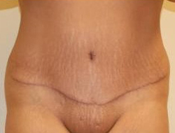 Tummy Tuck Before & After Photo