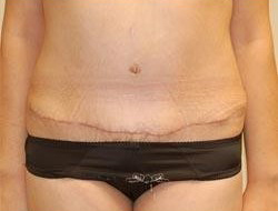 Tummy Tuck Before & After Photo