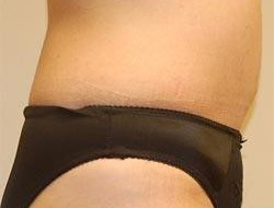 Tummy Tuck Before & After Photo