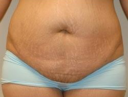 Tummy Tuck Before & After Photo