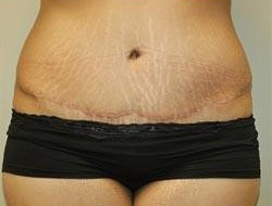 Tummy Tuck Before & After Photo