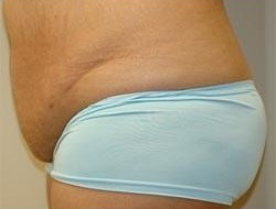 Tummy Tuck Before & After Photo