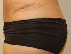 Tummy Tuck Before & After Photo