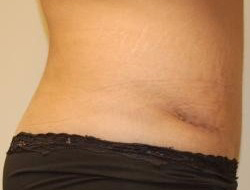 Tummy Tuck Before & After Photo