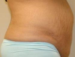 Tummy Tuck Before & After Photo