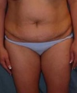 Tummy Tuck Before & After Photo