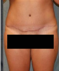 Tummy Tuck Before & After Photo