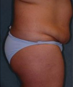 Tummy Tuck Before & After Photo