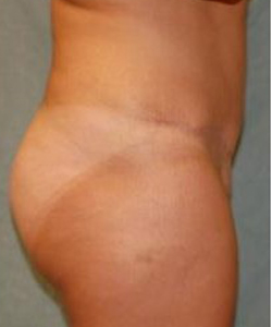 Tummy Tuck Before & After Photo