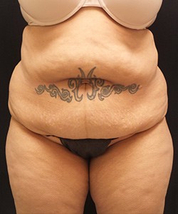 Tummy Tuck Before & After Photo