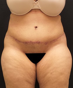 Tummy Tuck Before & After Photo