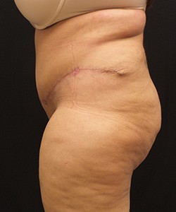 Tummy Tuck Before & After Photo