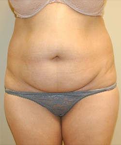 Tummy Tuck Before & After Photo