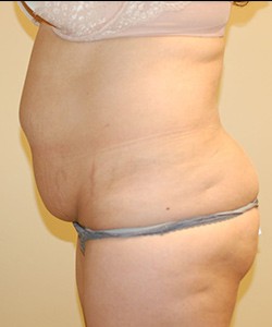 Tummy Tuck Before & After Photo