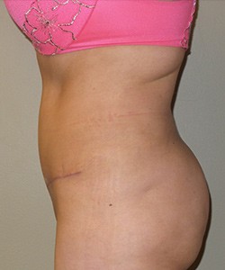 Tummy Tuck Before & After Photo