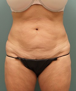 Tummy Tuck Before & After Photo